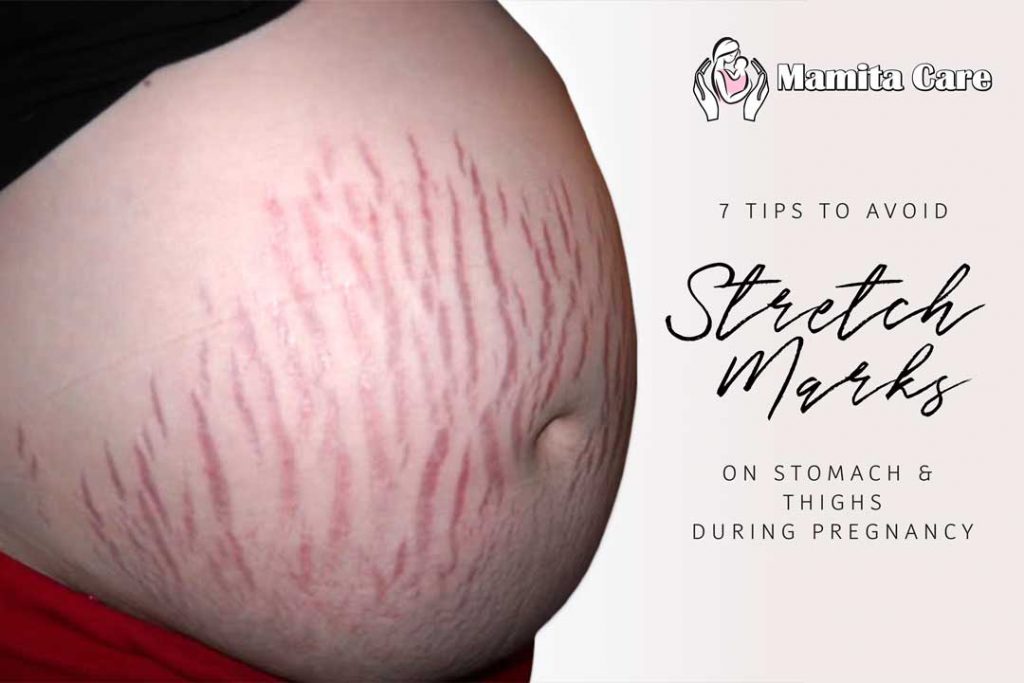 7-tips-to-avoid-stretch-marks-on-stomach-and-thighs-during-pregnancy