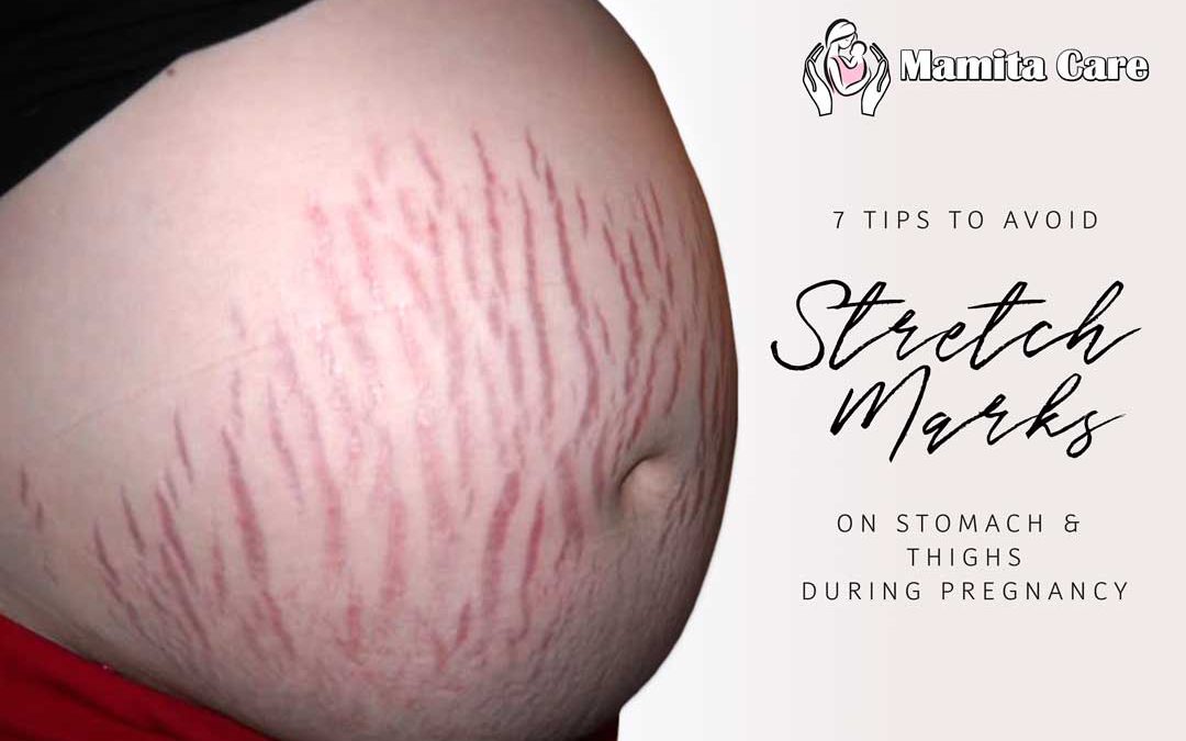 7 Tips to Avoid Stretch Marks Incidence on Stomach and Thighs During Pregnancy